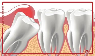 دندان نهفته چه عوارضی دارد؟